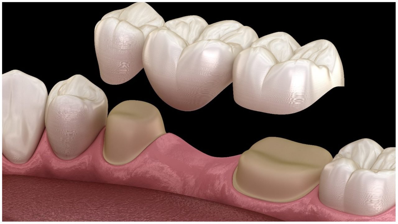 🦷 Fixed Prosthodontics | أساسيات التركيبات الثابتة بطريقة سهلة