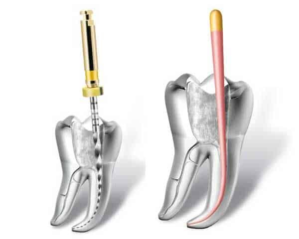 Endodontics 